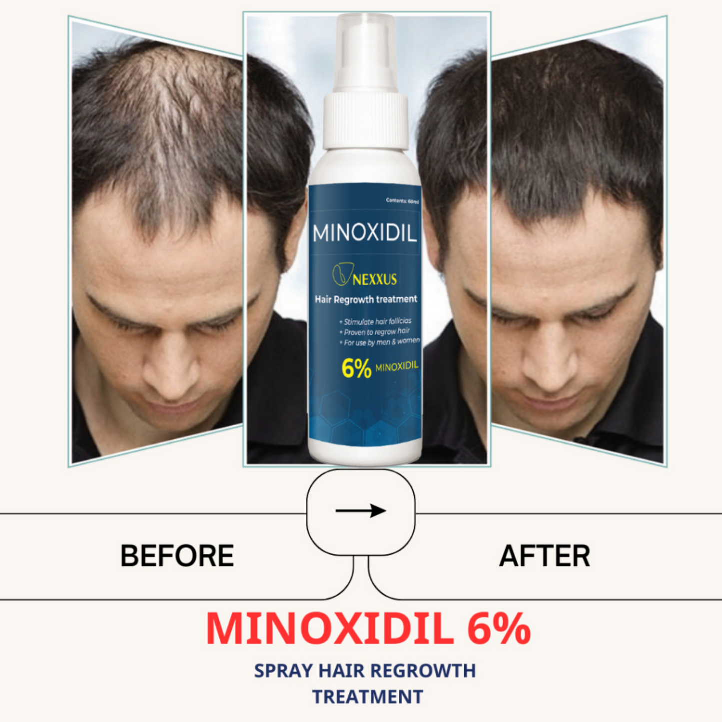 NEXXUS MINOXIDIL HAIR SPRAY (AUTHENTIC)