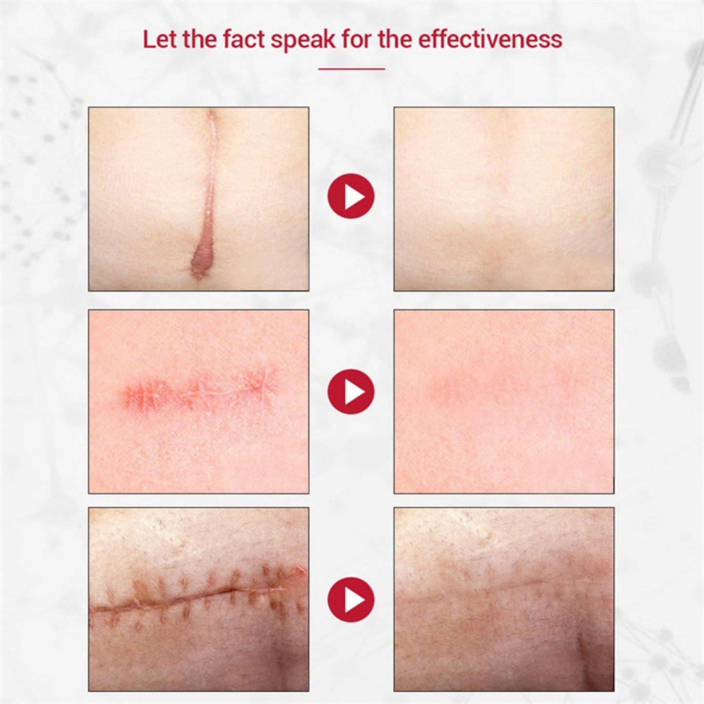 DERMATIX ULTRA - ADVANCE SCAR REMOVAL GEL